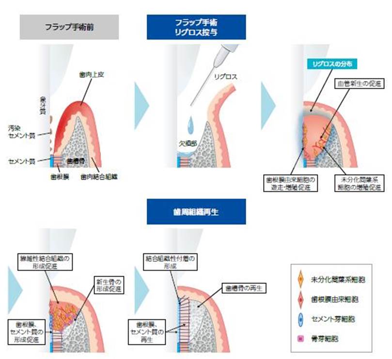 世界発「歯周組織再生医薬品」リグロス-歯周組織再生剤-