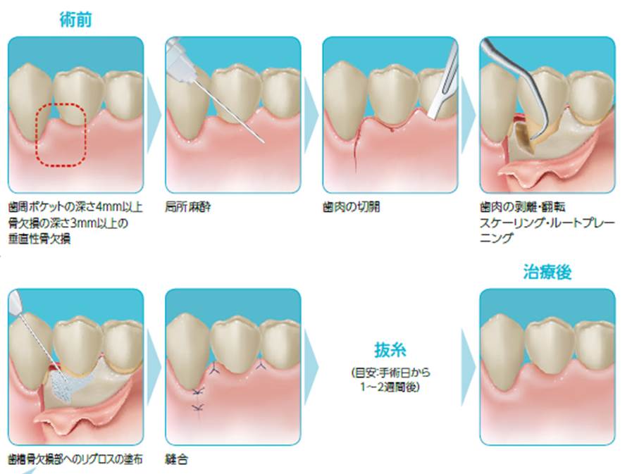 世界発「歯周組織再生医薬品」リグロス-歯周組織再生剤-