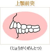 上顎前突（じょうがくぜんとつ）