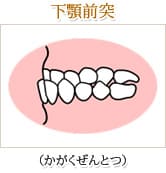 下顎前突（かがくぜんとつ）