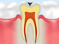 エナメル質の虫歯