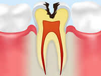 象牙質に達した虫歯