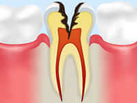 歯の神経にまで達した虫歯