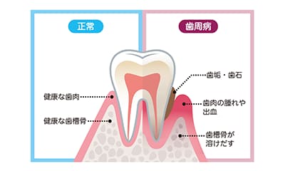 歯周病とは