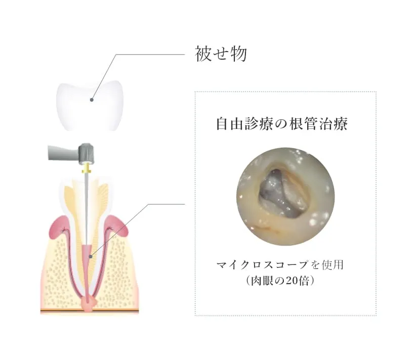 自由診療の根管治療