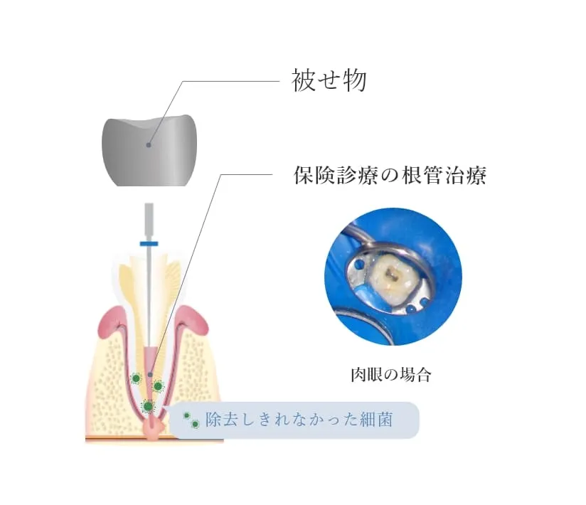 保険診療の根管治療